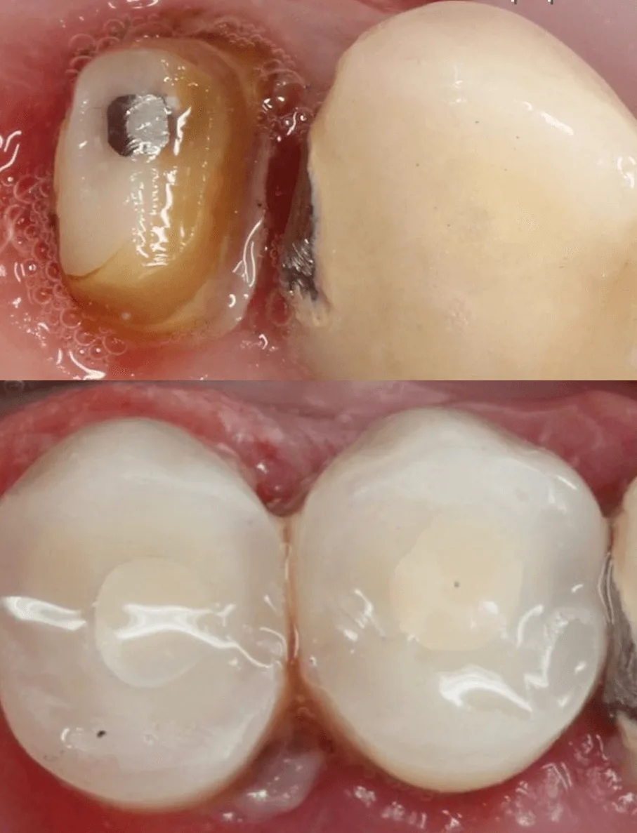 Импланты Штрауман